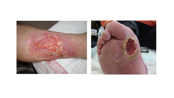 Wound types images